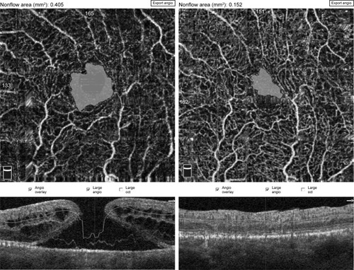 Figure 1 Pre- and postoperative FAZ measurement using a nonflow software in an 82-year-old male patient.