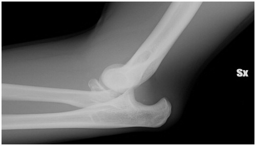 Figure 1. Radial head fracture (Mason IV).