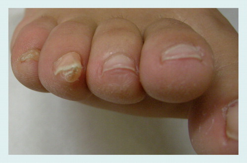 Figure 12. Subungual exostosis of the fourth right toenail in a 13-year-old boy who played soccer: the subungual mass uplifts the nail plate.