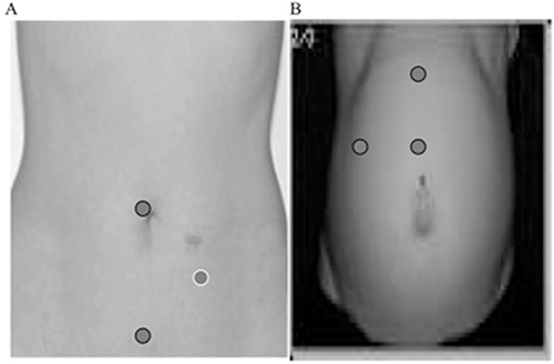 Figure 2 Example trocar placement (indicated by circles) in nonpregnant (A) and pregnant women in the third trimester (B).