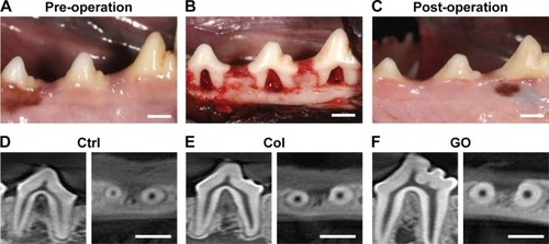 Figure 4 Digital photographs and CT images of dog class II furcation defects.Notes: (A) Pre-operation. (B) Surgically created furcation defects. (C) Postoperation. (D–F) CT images of furcation receiving no implantation (D), collagen scaffold (E), and GO scaffold (F) at 4 weeks postsurgery. Scale bars represent 5 mm.Abbreviations: Col, collagen; Ctrl, control; GO, graphene oxide.