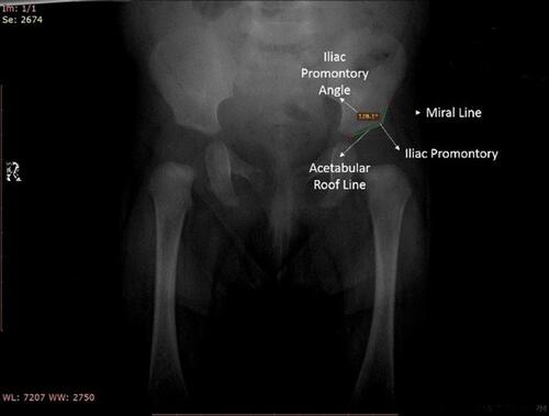 Figure 1 Illustration to the components that form the Iliac Promontory Angle.