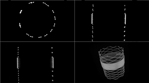 Figure 7 Orthogonal slices and 3D rendering (bottom right) of CT images throughout the outer blue part of the stent delivery system, revealing an internal metallic stent-like structure.