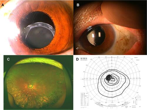 Figure 1 Case 1 was a 76-year-old woman with unstable vision. (A) At the initial examination, an inferiorly subluxed in-the-bag intraocular lens (IOL) can be seen in the left eye. (B) The scleral-sutured replaced posterior chamber-IOL was stable at 2 years after the surgery. (C) Fundus photograph at 5 years after the surgery. Multifocal chorioretinal atrophy can be seen. (D) Superiorly constricted visual field by Goldmann perimetry is present.