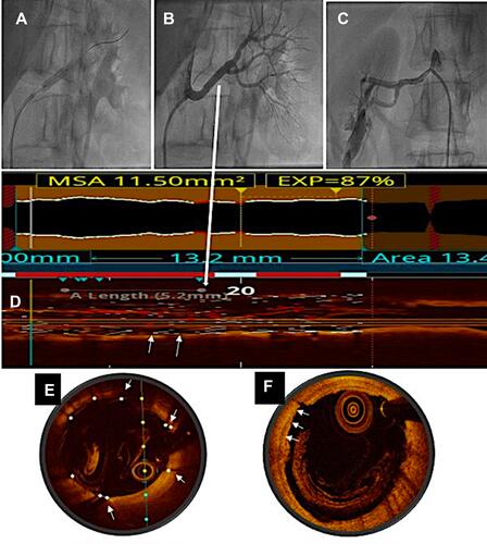 Figure 3 Angiogram showing stent deployment in the left renal artery (A) with an excellent angiographic result (B). The right renal artery shows (C) a good result with balloon angioplasty alone. Longitudinal (D) and cross-sectional (E) OCT images of left renal artery show good stent expansion and apposition (arrows) without residual stenosis. Cross-sectional OCT image (F) of right renal artery after balloon angioplasty shows good result with some intimal tears (arrows) and no residual stenosis (correlate with Image (C)).