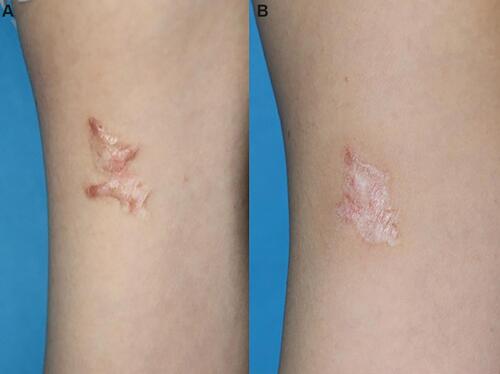 Figure 5 A patient with multiple lesions of keloids on her arm prior to treatment (A) and 1 year after PSR treatment with 2 radiation therapy thereafter (B). No recurrence was found.