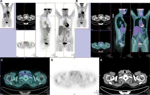 Figure 1 Breast cancer patient with rising tumor marker (cancer antigen 15.3) and negative CT scan.