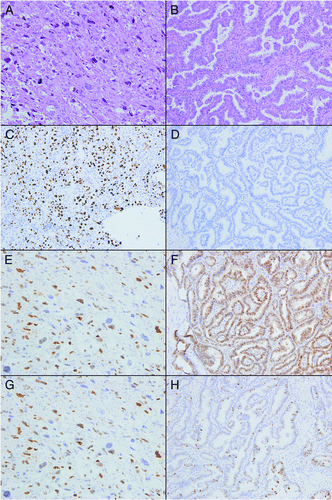 Figure 1. Hematoxylin and eosin stained sections of anaplastic (A) and papillary (B) thyroid carcinoma. ATC (C) showed a significant increase in staining for p53 as compared with PTC (D). Both ATC (E) and PTC (F) showed diffuse positive staining for cyclin D1. Although not statistically significant, ATC (G) was less likely to be p21 positive than PTC (H). Original magnification 200 x for all images.