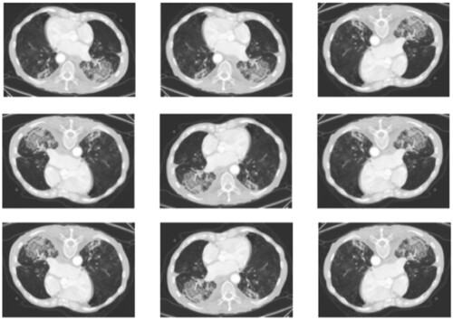 Figure 3. Sample augmented CT scan images when random flip technique is applied.