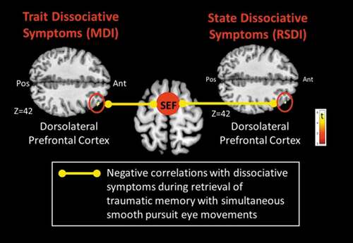 Figure 4. Explorative negative functional connectivity correlations with clinical dissociative measures in the right supplementary eye field (SEF) psychophysiological interaction during the traumatic memory retrieval condition. During retrieval of a traumatic memory with horizontal smooth pursuit eye movements, trait dissociation [Multiscale Dissociation Inventory (MDI)] symptoms and state dissociation symptoms [Responses to Script-Driven Imagery Scale (RSDI)] measures collected just prior to the scan correlated negatively with right SEF connectivity with the right dorsolateral prefrontal cortex. Pos, posterior; Ant, anterior. Results are shown at pFWE ≤ 0.0125, k = 10, corrected for multiple comparisons.