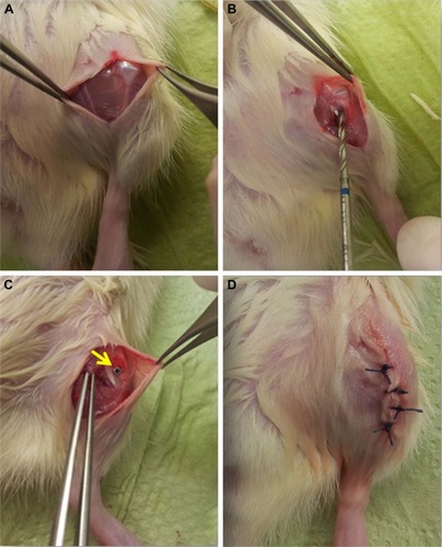 Figure 2 Surgical procedure shown in four steps.Notes: (A) Exposed knee cap after incision; (B) drill between the medial collateral ligament and patella tendon; (C) inserted implant (marked with yellow arrow); and (D) skin suture.