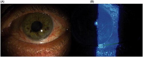 Figure 3. Slit lamp picture of dry eye disease (A); Alteration of fluorescein distribution and reduction of BUT (B).