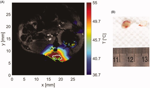 Figure 9. (A) Sample temperature map shown over the magnitude image at the end of ablation. White contour stands for segmented tumor and green contour for area with thermal dose greater than 240 CEM43. (B) Extracted tumor with applied TTC staining (white tissue) and surrounding vessels (red tissue).
