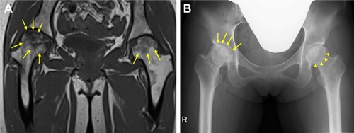 Figure 3 Radiographic images of the hips on high-dose corticosteroid therapy for refractory alopecia areata.