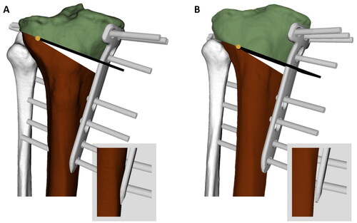 Figure 7. Comparison between automated and manual solutions of one case. (A) Manual solution: The plate is placed too proximal and therefore, the screws are very close to the tibial plateau, which causes a high risk for fractures into the plateau. The screw S4 is located too close to the cut. Furthermore, the distal end of the plate penetrates the bone. (B) Algorithm solution: The osteotomy axis and cut as well as the plate is placed more distally, leaving enough security margin between screws and tibial plateau. Screw S4 has enough distance to the osteotomy cut and the distal end of the plate does not penetrate the bone.