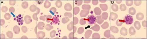 Figure 3 Typical abnormal platelet morphological change of COVID-19 subjects. (A) Platelet aggregation (blue arrows); (B) platelet aggregation (blue arrows) and giant platelet (red arrows); (C) giant platelet (red arrows) with distinct protrusions resembling pseudopodia (black arrows). (D) Giant platelet (red arrows). (Wright-Giemsa stain, ×100).