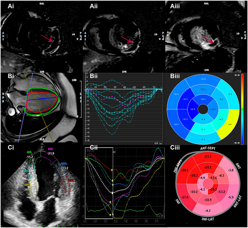 Figure 1 Typical CMVO appearance on LGE-CMR images (A) and measurement of myocardial longitudinal peak systolic strain using CMR-FT (B) and STE+LDDSE (C). Red arrow represents CMVO within infarcted myocardium segment (Ai: basis, Aii: middle, Aiii: apex), (Bi and Ci) represent longitudinal peak systolic strain measurements of CMR-FT and LDDSE, respectively. (Bii and Cii) represent longitudinal peak systolic strain–time curve of CMR-FT and LDDSE, respectively. (Biii and Ciii) represents bull’s eye plot of CMR-FT and LDDSE, respectively.