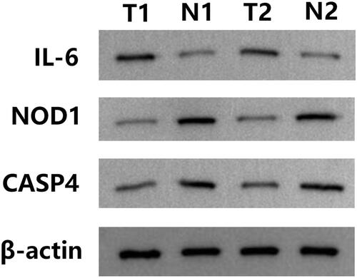 Figure 12 Relative protein expression of three pyroptosis-related genes in clinician-collected tissue. N1 and N2 represent non-tumor tissues, and T1 and T2 represent tumor tissues.
