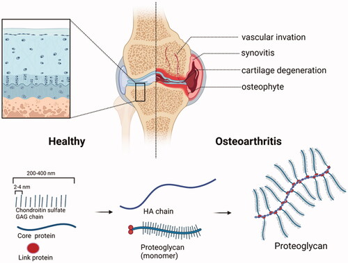 Figure 2. Structural changes of joints before and after OA and schematic diagram of aggrecan. Structural comparison of healthy joints and osteoarthritis (OA) joints. OA involves synovitis, cartilage degeneration, osteophyte formation and joint pain. Small molecular GAG is like a mane on a test tube brush. It binds to the core protein by a covalent bond and radiates outward with the core protein in the center, and then binds to the hyaluronic acid trunk to form an aggrecan. (Created with BioRender.com).