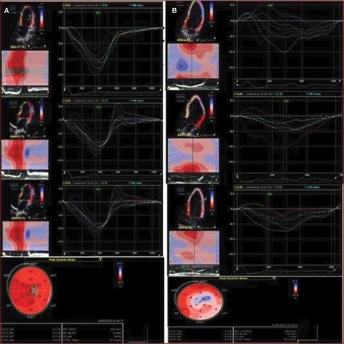 Figure 4 Speckle tracking imaging of the left ventricle longitudinal strain, before (A) and after (B) doxorubicin therapy, in a control group patient.