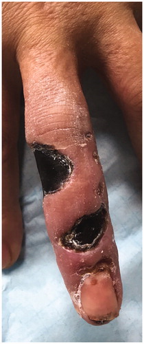 Figure 8. Skin with deep necrosis ulcers (12th day post trauma - dorsal view).