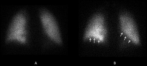 Figure 5 99mTc macroaggregated albumin pulmonary perfusion scan: change in regional pulmonary perfusion as a result of posture. Lower lobes are affected by gravity.