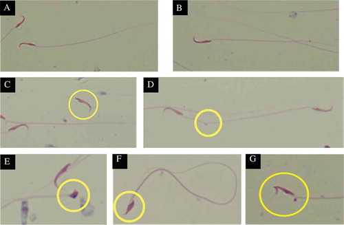 Figure 2. Comparison of normal and abnormal sperm morphology, X400. (A and B) Show normal sperm morphology; hook head and long tail. (C) Shows abnormal tailless sperm. (D) Depicts a bend at a point on the sperm tail. (E–G) Show abnormally developed sperm head; knobbed, short and no hook, and bent sperm head, respectively. Sperm were stained with Diff-Quik staining kit.