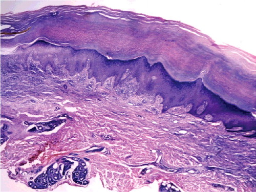 Figure 4. Arsenical keratosis. Histopathology of keratosis plaques on acral limbs showed epidermis hyperplasia, diffuse lymphocyte infiltration and collagen fiber eosinophilic changes in the dermis.