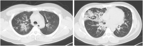Figure 1 A chest computed tomography (CT) scan in Case 1 shows infiltrative and nodular shadows with pneumatocele formation in the right upper lobe.
