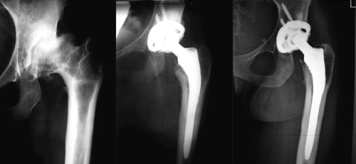 Figure 1. 26-year-old woman with severe secondary OA of the left hip, femoral deformity, and varisation osteotomy. Radiographs (left to right) preoperatively, and 1 year and 15 years postoperatively.