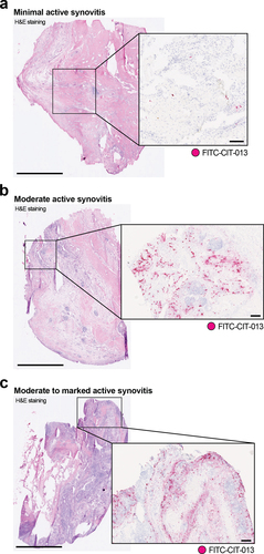 Figure 1. Elevated CIT-013 epitope in RA synovial tissue with moderate to marked active synovitis.