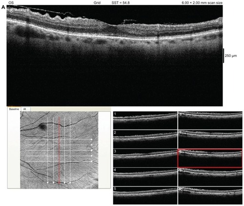 Figure 1 Posterior Segment Optical Coherence Tomography (OCT) of the left eye revealing an epiretinal membrane.