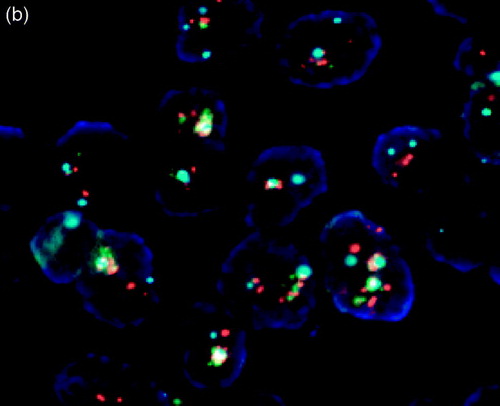 Figure 1b.  FISH analysis of cancer cells showing HER-2 and TOP2A coamplification. There are three CEP 17 (aqua) and greater than ten signals for both HER-2 (green) and TOP2A (red) genes. Genes to chromosome ratio >3.
