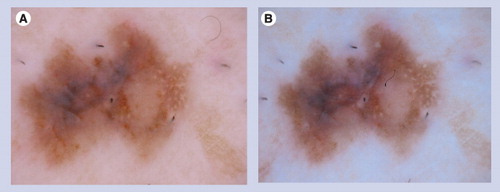 Figure 14. Spitz nevus by view of polarized and nonpolarized dermoscopy.A focal area with a negative network is visible on nonpolarized dermoscopy (A) and polarized dermoscopy (B). The negative network is located on the right side of the lesion at approximately 3 o’clock.
