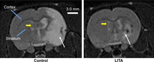 Figure S2 Typical coronal in vivo T2-weighted magnetic resonance images of the brain at −0.10 Bregma of control and liposomal encapsulated acetate (LITA) treated rats at 2 weeks after middle-cerebral artery occlusion.Notes: White and yellow arrows indicate the infarct area and anterior lateral ventricle, respectively. Scale bar: 3.0 mm.