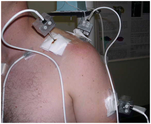 Figure 1. Intracortical pin placement in humerus and scapula in a representative subject.