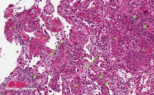 Figure 2. Transbronchial biopsy showing interstitial inflammatory infiltrates (short arrows), with fibrinous exudates filling alveolar spaces (*) and foci of intra-alveolar organizing fibrosis (long arrows). Hematoxylin & eosin stain, scale bar = 200 micrometers.