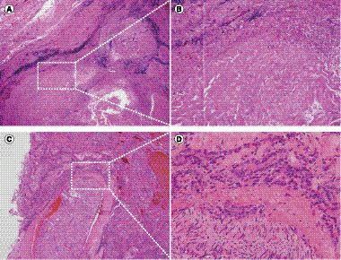 Figure 4. Efficacy of lenvatinib was pathologically confirmed.Microscopic images of surgical specimen: (A & C): 20x; (B & D): 200x. (A & B) Hematoxylin and eosin (H&E) and Elastica-van-Gieson staining focusing on encased internal jugular vein revealed that tumor was replaced with necrotic tissue and fibrosis, and viable tumor cell was not observed in this area. (C) & D) H&E staining of mediastinal part of tumor represents viable tumor cell infiltration around recurrent laryngeal nerve.