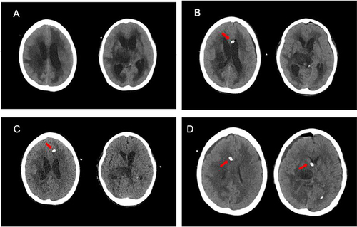 Figure 1 Brain CT before and after endoscopic third ventriculostomy and left EVD. (A) Brain CT scan on admission showing severe hydrocephalus and interstitial brain edema; (B) brain CT scan after endoscopic third ventriculostomy and left EVD in our hospital; (C) brain CT about one month after endoscopic third ventriculostomy and left EVD showing improvement of interstitial cerebral edema, but hydrocephalus was still present; (D) brain CT after a new right EVD was placed due to deterioration of intracranial Myroides odoratimimus infection while hydrocephalus was significantly better than before. Red arrow: catheter of EVD.