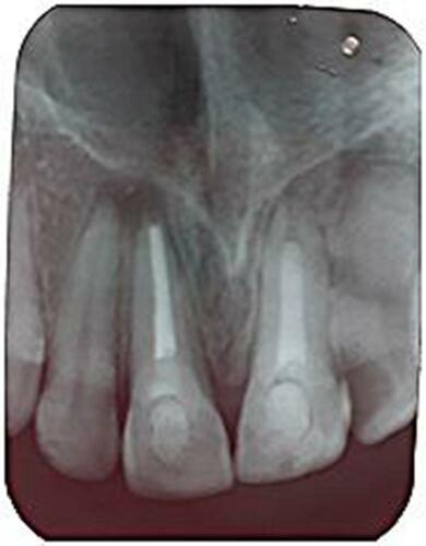 Figure 3 Image taken 9 months later revealing significant remineralization in the periapical region.