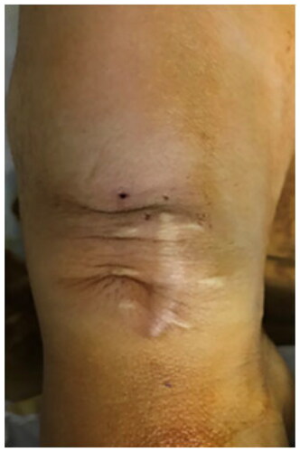 Figure 5. A representative picture shows the skin condition of the patient’s surgical site.