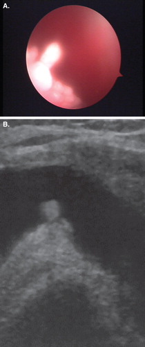 Figure 1. (A) Arthroscopic image: villous proliferation of the synovial membrane of the suprapatellar pouch of a patient affected by psoriatic arthritis. (B) The same image captured with an US device during the same examination.