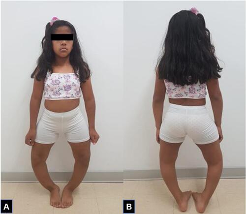 Figure 1 Anterior (A) and posterior (B) view of the patient at 15 years of age.