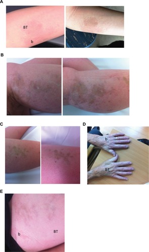 Figure 1 (A). Plaque morphea. Pre-(left side) and immediate posttreatment images. Betamethasone treatment site is labeled b and betamethasone/tranilast site is labeled BT. Persisting erythema indicating ongoing disease activity is noted at the b site whereas the disease has resolved with post inflammatory hyperpigmentation at the BT site. (B) Linear morphea. Pre- and immediate posttreatment images at the b treatment site demonstrating disease progression has occurred over 3 months. (C) Linear morphea. Pre- and immediate posttreatment images at the Figure 1B adjacent BT treatment site demonstrating no disease progression. (D) Limited scleroderma. Immediate post-treatment image. There is persisting induration at the b site compared to the BT treatment site. (E) Linear morphea post treatment image. The BT has improved more quickly than the b site at the completion of the 3-month trial.