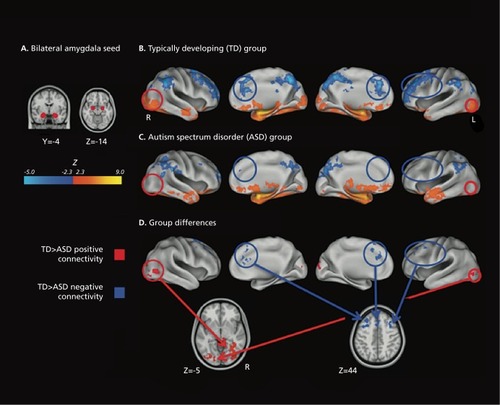 Figure 6. Functional connectivity in autism. Bilateral amygdala connectivity. (A) The Harvard-Oxford bilateral amygdala (25% probability) used as seed region and displayed on the 1 mm MNI152 T1 standard brain. (B) Typically developing (TD) within-group connectivity maps, (C) Autism spectrum disorder within-group connectivity maps, and (D) direct between-group contrasts rendered on the Inflated PALS B12 brain using CARET (Computerized Anatomical Reconstruction and Editing Toolkit) and on the 1 mm Montreal Neurological Institute (MNI)152 T1 standard brain using Analysis of Functional Neurolmages. Maps are thresholded at Z > 2.3 (P< 0.01) with correction for multiple comparisons applied at the cluster level (P< 0.05). Red circles highlight areas of greater positive connectivity with the seed region for the TD group. Blue circles highlight areas of greater negative connectivity with the seed region for the TD group. The original paper also details the connectivity of the right inferior frontal gyrus, pars opercularis. Adapted from ref 91: Rudie JD, Shehzad Z, Hernandez LM, et al. Reduced functional integration and segregation of distributed neural systems underlying social and emotional information processing in autism spectrum disorders. Cereb Cortex. 2012;22:1025-1037. Copyright © Oxford University Press 2012