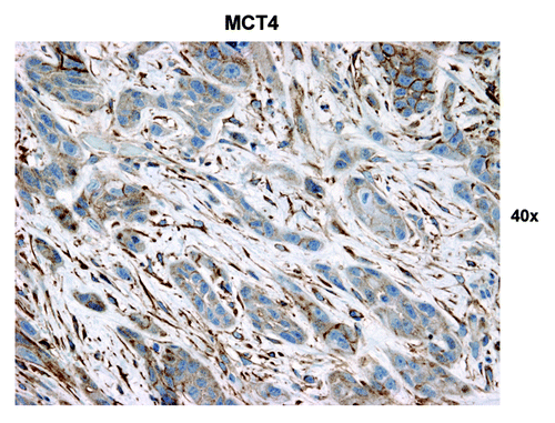 Figure 9. MCT4 stromal immunostaining in HNSCC tumor tissue. Note that the stromal cells separating nests of proliferating carcinoma cells have the highest MCT4 expression (brown). Original magnification: 40×, as indicated.