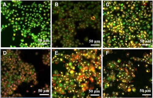 Figure 5 Apoptosis analysis in HeLa cells treated with Au@MPA-PEG-FA-PTX and PTX by AO/EB staining. (A) Control; (B–E) Au@MPA-PEG-FA-PTX (3, 5, 10, 15 μg/mL); (F) PTX: 15 μg/mL.