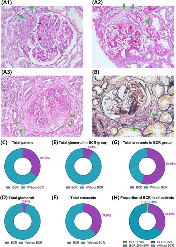 Figure 1. Typical photomicrograph of Bowman’s capsule rupture (BCR) in patients with IgAV-N by PAS and PASM staining and summary of BCR in renal biopsy. (A, B) Representative periodic acid-Schiff (PAS) and periodic acid-silver metheramine (PASM) photomicrograph of Bowman’s capsule rupture (BCR) in patients with IgAV-N (×400). A1-A3 show cellular, fibro-cellular, and fibrous crescents with BCR, respectively. The green arrows indicate disruption of Bowman’s capsule, and the small black arrows show glomerular mesangial proliferation. (C) Patients with BCR in total cases. (D) Glomeruli with BCR in the total glomeruli. (E) Glomeruli with BCR in the total glomeruli in the BCR group. (F) Glomeruli with BCR in all glomeruli with crescents. (G) Glomeruli with BCR in all glomeruli with crescents in the BCR group. (H) Proportion of glomeruli with BCR in total cases.