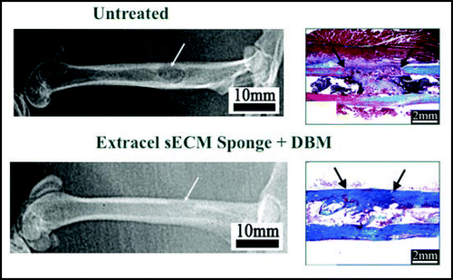Figure 7 Bone repair in a femoral defect model with a cell-free two-component Extracel™ lyophilized sponge containing human demineralized bone matrix (DBM). Above, untreated control injury results in little defect closure (autoradiogram) and extensive scar tissue (histology). Below, optimal treatment with Extracel™ sponge plus DBM shows complete closure of the defect and filling of the defect with healthy bone tissue.