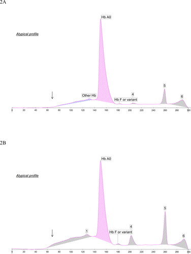 Figure 2. HbA1c electropherograms of (A) the index case of homozygous Hb Tacoma, and (B) the homozygote Hb Tacoma observed among the South Ostrobothnian cohort. Non-glycated Hb Tacoma is falsely interpreted as HbA0, which shifts scale to left and misplaces HbF (at x-axis around 205, marked 4) and HbA2 (at x-axis around 260, marked 5). Peak 6 is characteristic of degraded hemoglobin. In (A) HbA1c is absent, and in (B) the corresponding area is masked by the white area (marked by arrows).